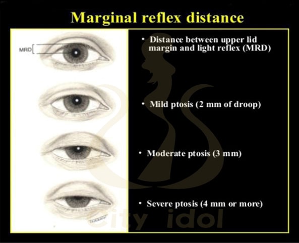 眼瞼下垂嚴重程度分類